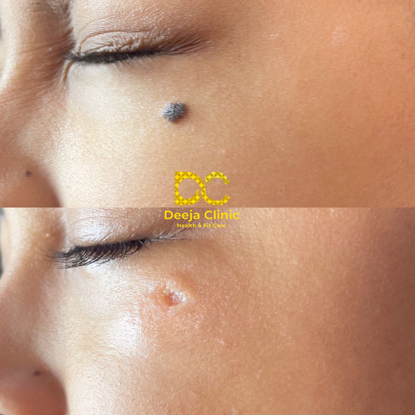 Hasil Treatment Tahi Lalat 2