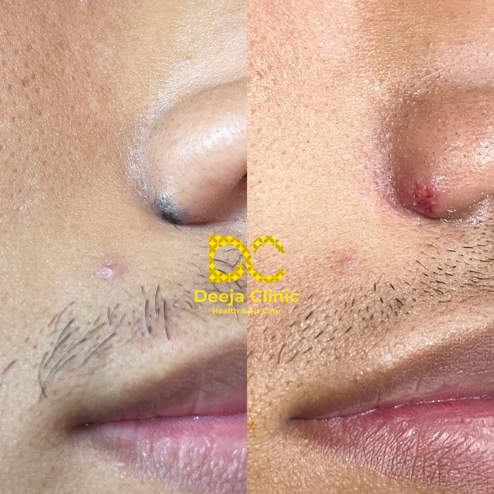Hasil Treatment Tahi Lalat 4