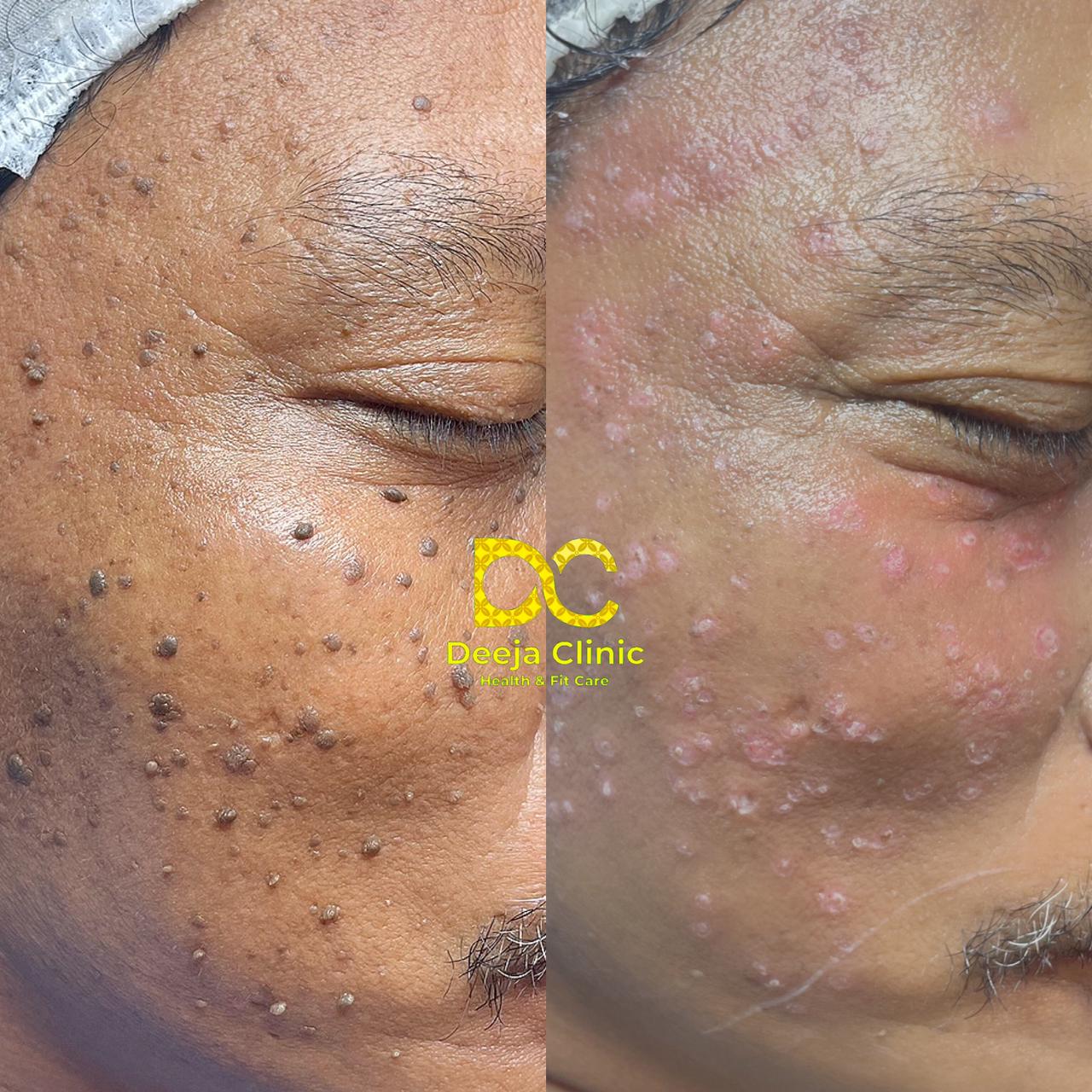 Hasil Treatment Kutil 2