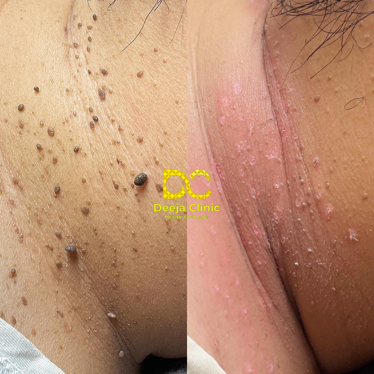Hasil Treatment Kutil 1