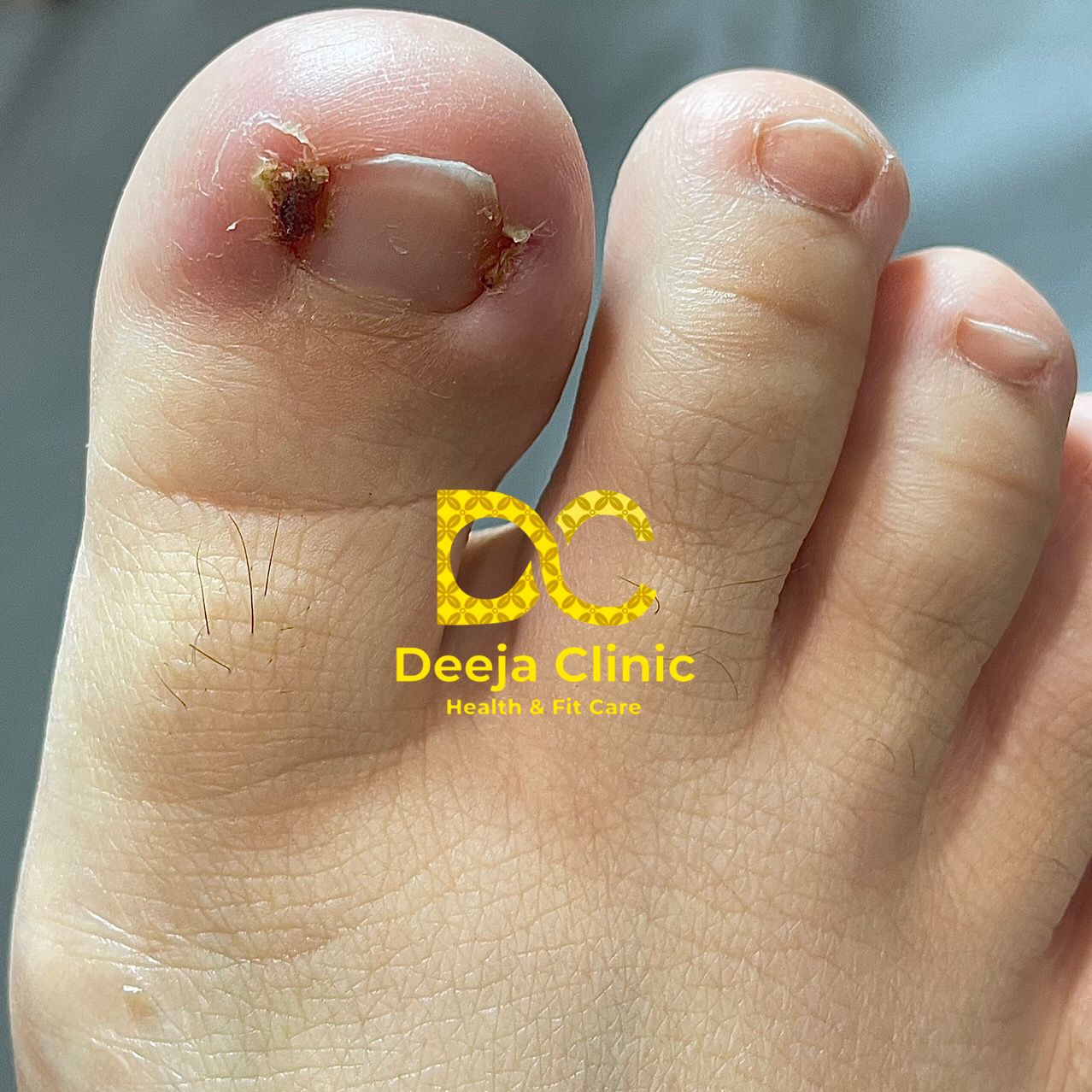 Kasus Cantengan Deeja Clinic - Tindakan Medis