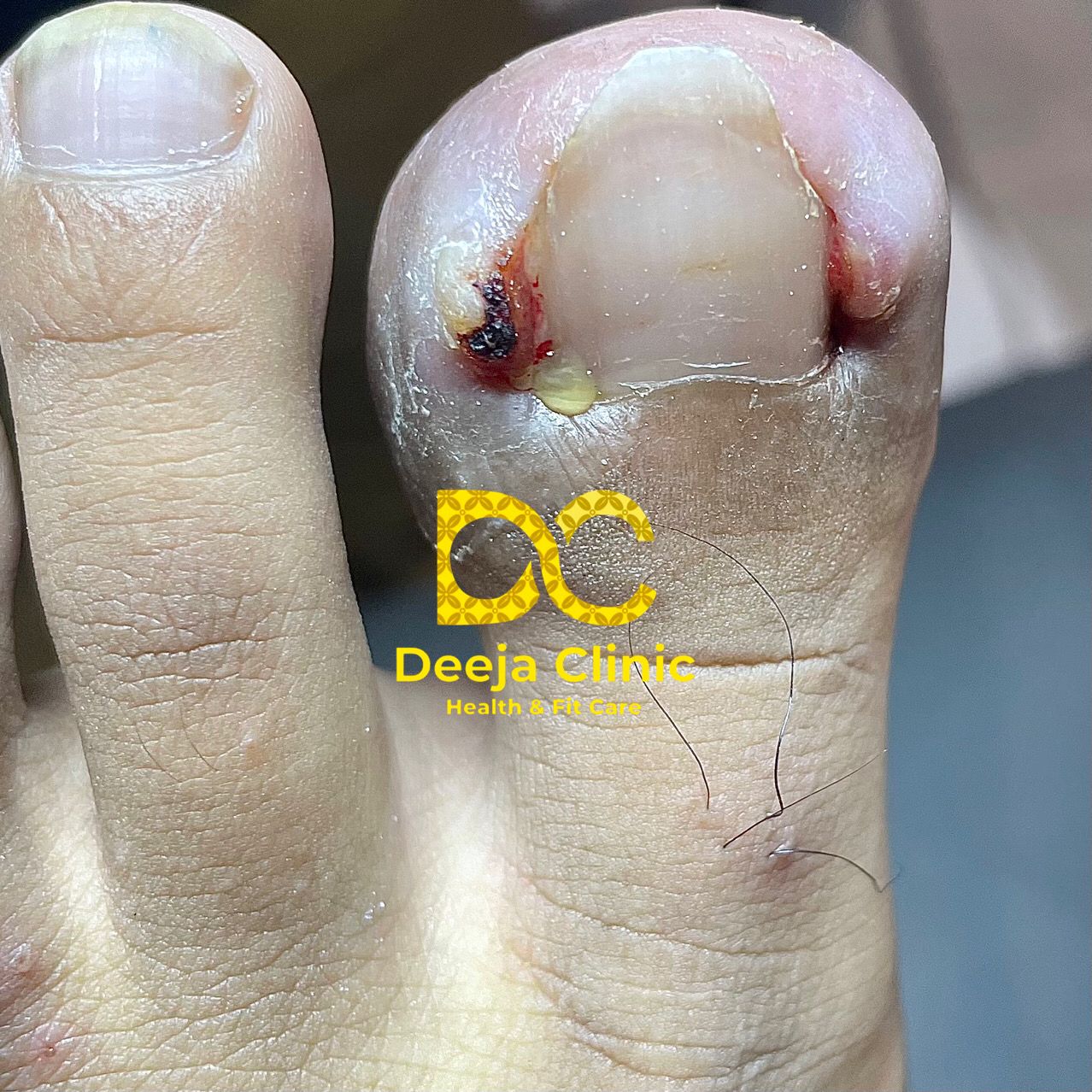 Kasus Cantengan Deeja Clinic - Hasil Sembuh