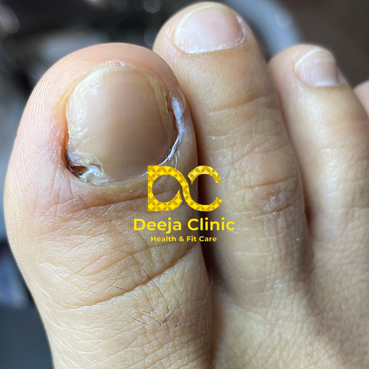 Kasus Cantengan Deeja Clinic - Evaluasi Medis