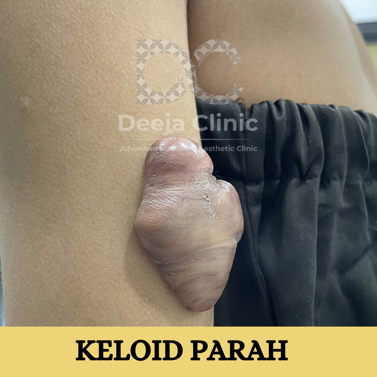 Contoh kasus keloid parah