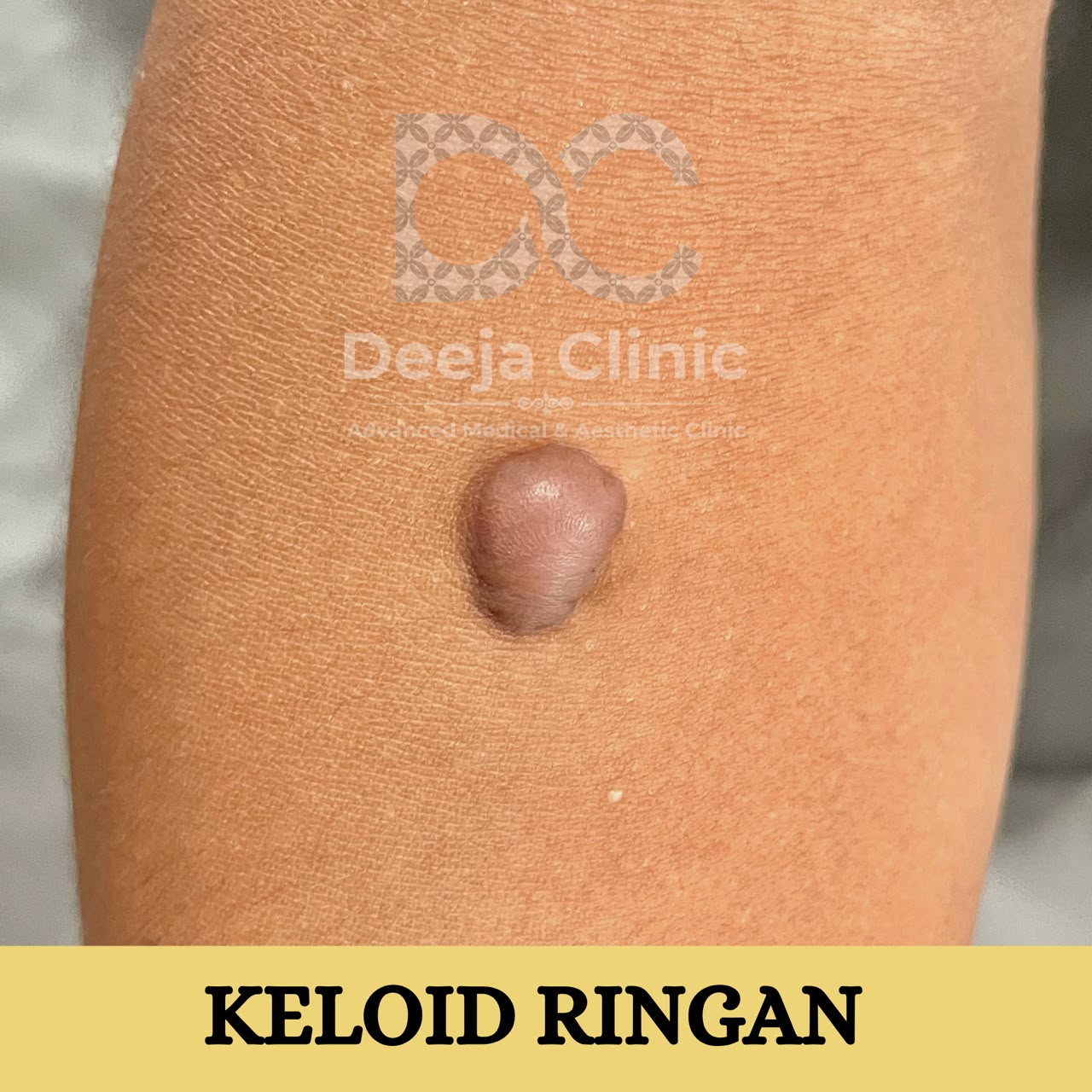 Contoh kasus keloid ringan