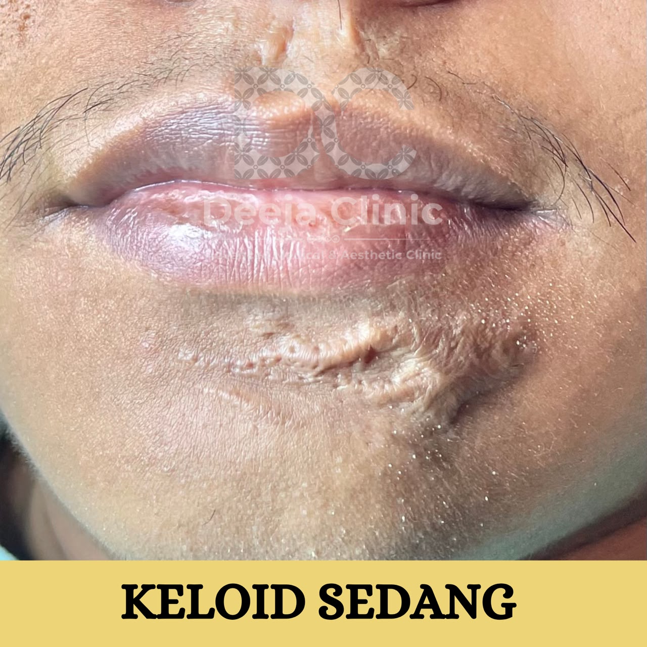 Contoh kasus keloid sedang