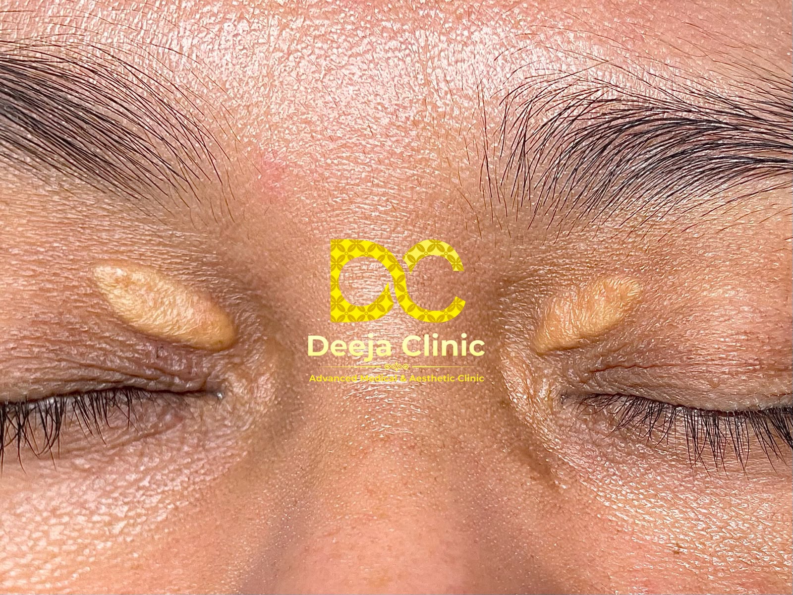Xanthelasma